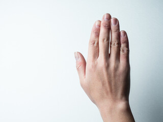 しもやけ・あかぎれ・凍傷で腫れた女性の手