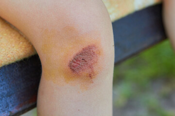 a wound on the knee kid,close-up of a healed wound on the child's knee, an injury on the knee