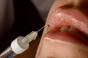close-up of syringe needle with drop of the drug near the female lips. Lip augmentation.