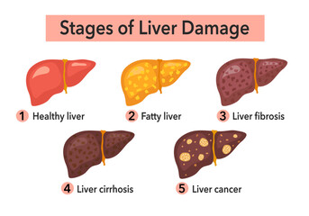 Stages of liver damage infographic concept vector illustration. Fatty liver, cirrhosis and liver cancer in flat design on white background.