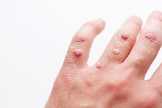 Closeup of finger wart isolated on white background. Skin diseases. Viral wart on hand