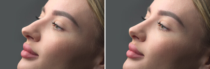 Nose Before and after plastic surgery. Rhinoplasty. Crooked nose correcting. Young woman profile portrait, over grey background. Beauty female, model girl face close-up. Aesthetic medicine - obrazy, fototapety, plakaty