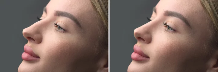 Muurstickers Nose Before and after plastic surgery. Rhinoplasty. Crooked nose correcting. Young woman profile portrait, over grey background. Beauty female, model girl face close-up. Aesthetic medicine © Subbotina Anna