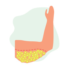 Illustration of fat cells lipodema on a woman's arm. Arm lift surgery concept