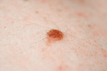 Mole birthmark nevus macro photo on human skin. crochordon or soft fibroma close up. dermatology problem skin concept