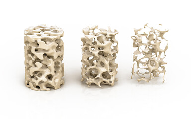 Bone structure 3d illustration, normal and with osteoporosis