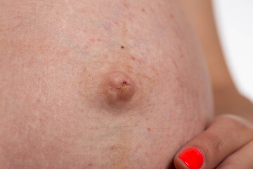 Convex navel on the stomach of a pregnant girl, close-up. Stretch marks on the skin, esthetic
