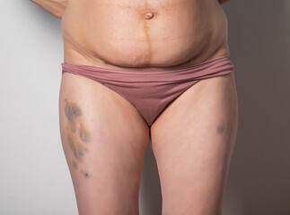 Bruises from injections on the girl's leg and a seam on her stomach from a caesarean section. The...
