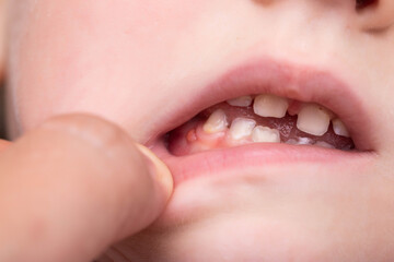 Fototapeta premium A bump is a tumor on the tooth gum in a child. Periodontitis in children due to a tooth with pulpitis. Close-up