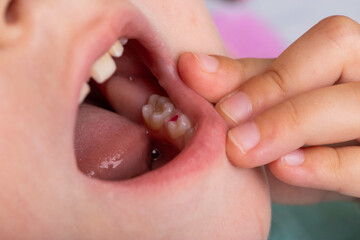 Installation of a colored red filling in a milk tooth for a child. Colored fillings in dentistry...