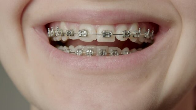 Wide smile of a woman close up. Natural and healthy teeth of a woman who straightens her teeth with metal brackets. Teeth straightening process. Dental and teeth care concept