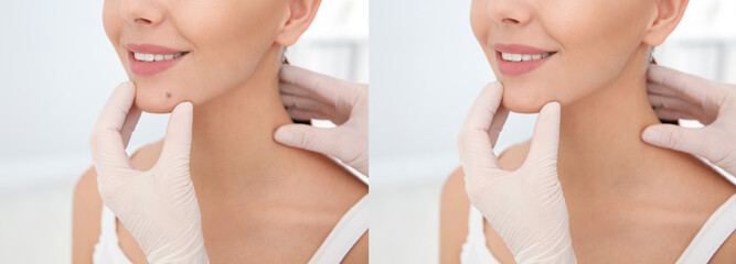 Collage with photos of patient's face before and after mole removing procedure, closeup....