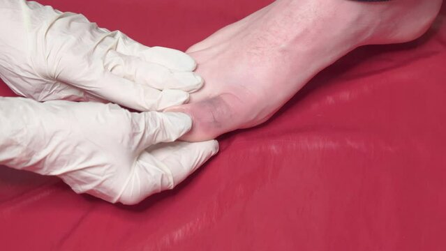 The hands of a doctor in medical gloves examine the bruised toe of a man.