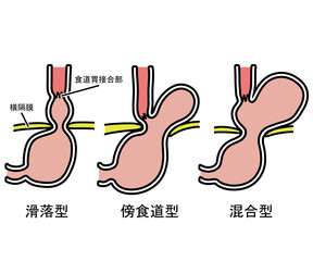 食道裂孔ヘルニア