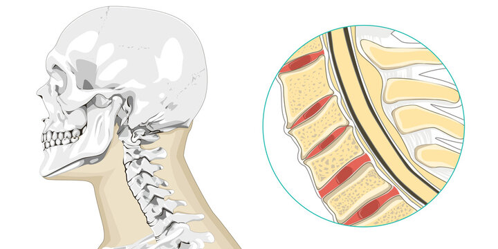 Spondylosis Bilder Durchsuchen 1,705 Archivfotos, und