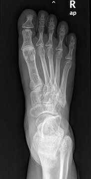 X-RAY AP VIEW AT RIGHT FOOT