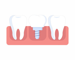 Healthy tooth and Dental Implant, Human teeth oral hygine.