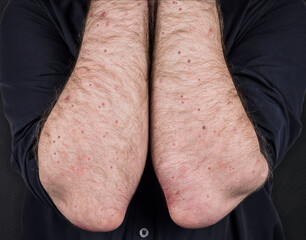 Measles. Viral disease of immunodeficiency dermatitis rash on the body of a man, scratch with itching, viral exanthema. A patient with monkeypox. Painful rash, red spots, blisters on the arm. - obrazy, fototapety, plakaty