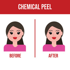 Chemical peel before after vector illustration