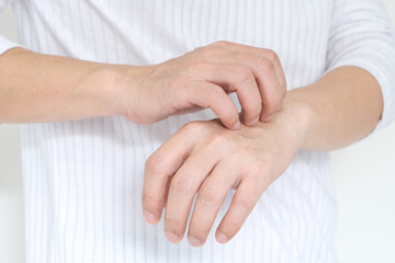 man's hand where he scratched his arm and wrist, he had itchy, inflamed skin and felt itchy.