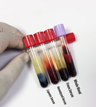 Lipemic blood sample, frees serum, whole blood, hemolyzed serum, Lipemia in a blood specimen can false result.