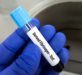 Test tube with blood sample for Derived fibrinogen test, coagulation disorder diagnosis. plasma...