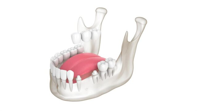 Mandible with dental bridge over molar and premolar teeth