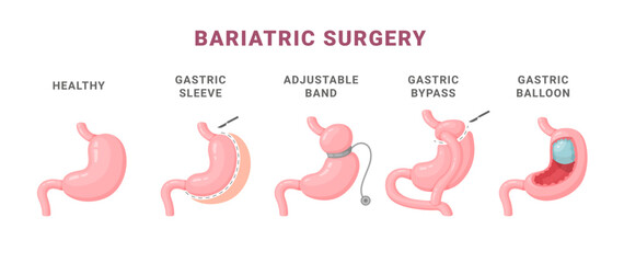 Fototapeta Bariatric surgery types information medical scheme vector isometric illustration obraz