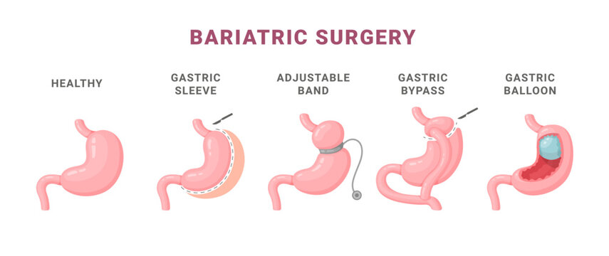 Bariatric surgery types information medical scheme vector isometric illustration