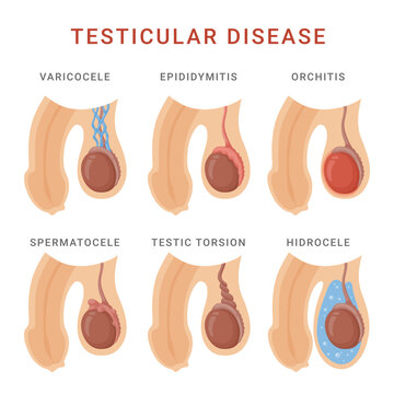 Testicular diseases types scheme male anatomy medical inflammation vector flat illustration