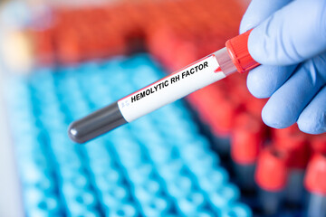 Hemolytic Rh Factor. Hemolytic Rh Factor disease blood test inmedical laboratory