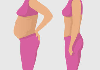 Vector illustration of a woman's body with a fat belly and a woman's body with a slender beautiful figure, before and after exercise for weight loss