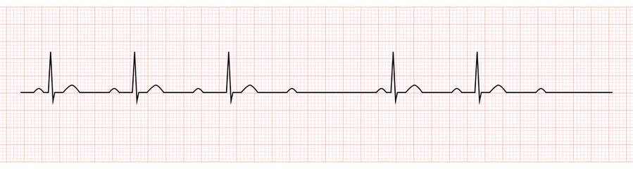 EKG Showing second degree av block mobitz I