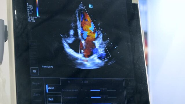 Utrasound image on the monitor close-up. Ultrasound Scan display. Screening Ultrasonography Analysis of person. Ultrasound examination Using Scanner. Ultrasound Scan Device. Echocardiography
