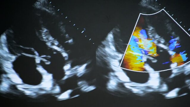 Utrasound image on the monitor close-up. Ultrasound Scan display. Screening Ultrasonography Analysis of person. Ultrasound examination Using Scanner. Ultrasound Scan Device. Echocardiography
