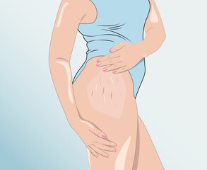 illustration. A woman after weight loss shows stretch marks on the skin of her legs and the outer and inner side of the thighs. Treatment of skin stretch marks in the clinic. - obrazy, fototapety, plakaty