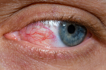 Przekrwione czerwone oko z widocznymi żyłkami 