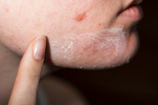 Skincare treatment on skin face
