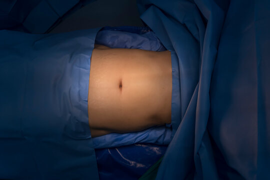 Preparation of the Abdomen before Laparoscopic Abdominal Surgery.Aseptic technique for set up patient before laparotomy.Surgeon prepare inside operating theatre.Medical and insurance concept.