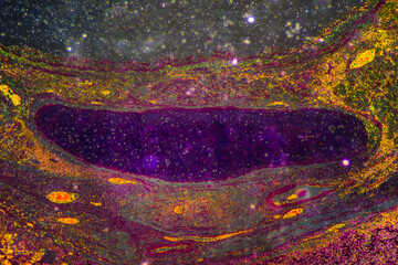 Chronic bronchitis disease human cells