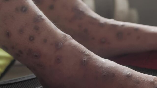 Foot with ulcer filled with pus condition caused of scabies infection, sensitive skin itchy health problem
