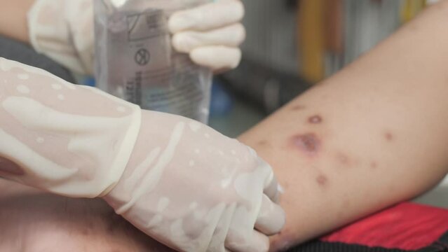 Nurse hand cleaning patient foot with ulcer filled with pus condition caused of scabies infection, sensitive skin itchy health problem