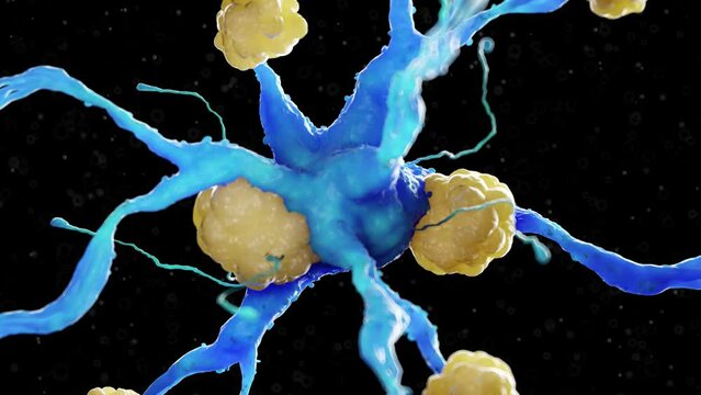 3D rendered medical animation of a nerve cell affected by amyloidosis