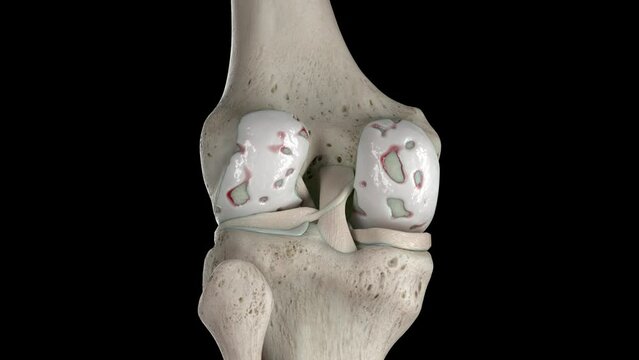 3D rendered medical animation of damaged knee cartilage