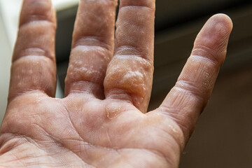 rash on fingers dyshidrotic eczema - obrazy, fototapety, plakaty
