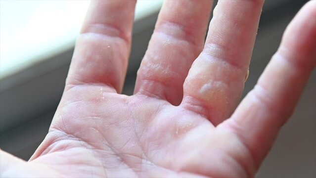 rash on fingers dyshidrotic eczema