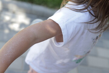 sunburn on the shoulder of a child, after a long time in the sun, the concept of skin protection.