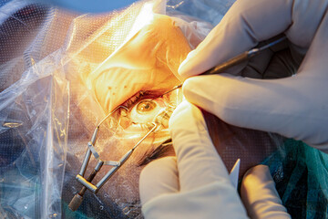 Eye surgery process, treatment of cataract and diopter correction. Surgical implementation of...