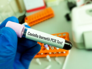 Blood sample for Q fever or query fever is a disease caused by infection with Coxiella burnetii.