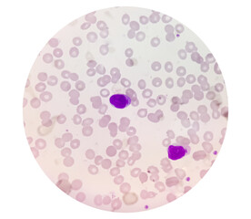 Photomicrographic view of Leukemia, hematological analysis.